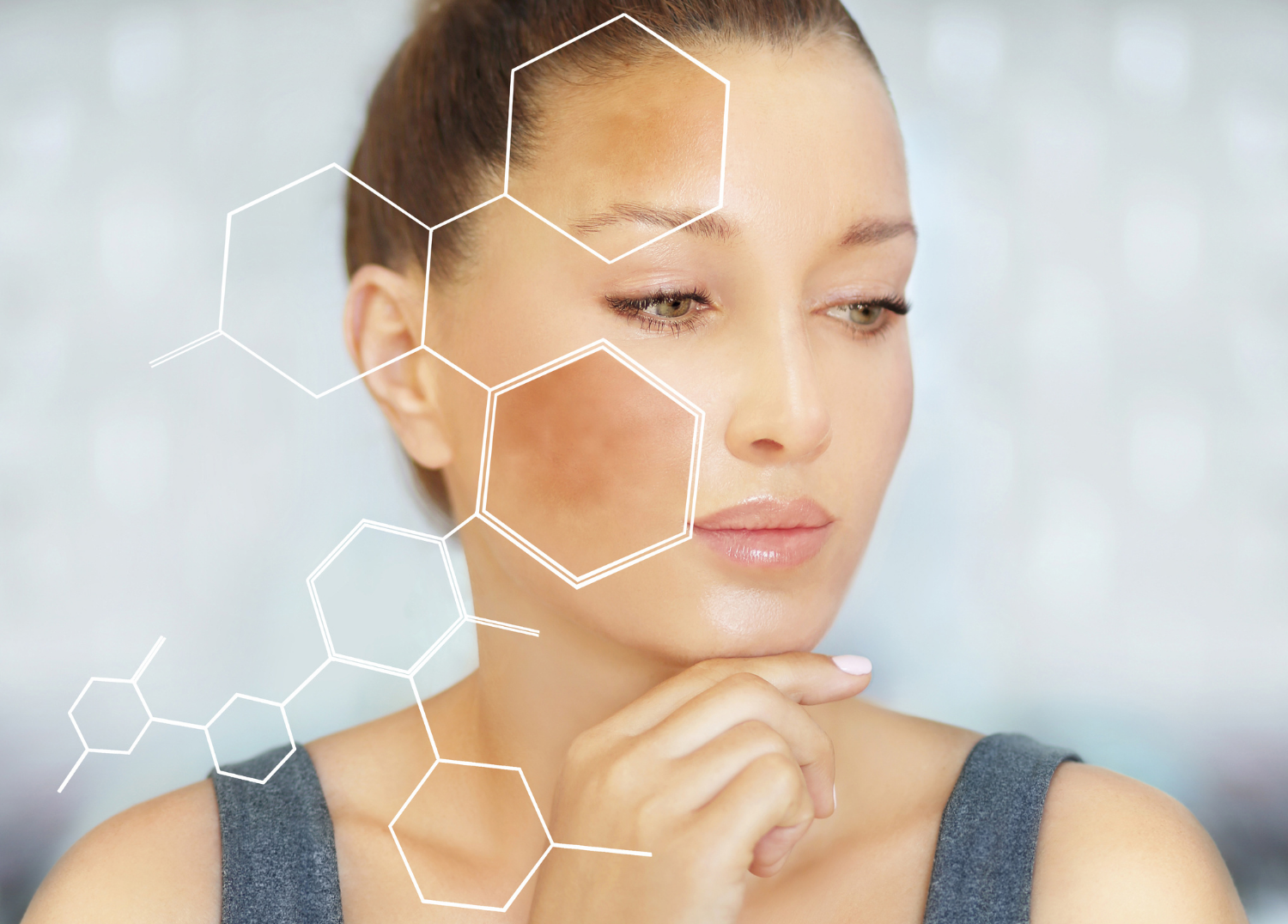 What is Melasma? Causes, Severity, and Treatment