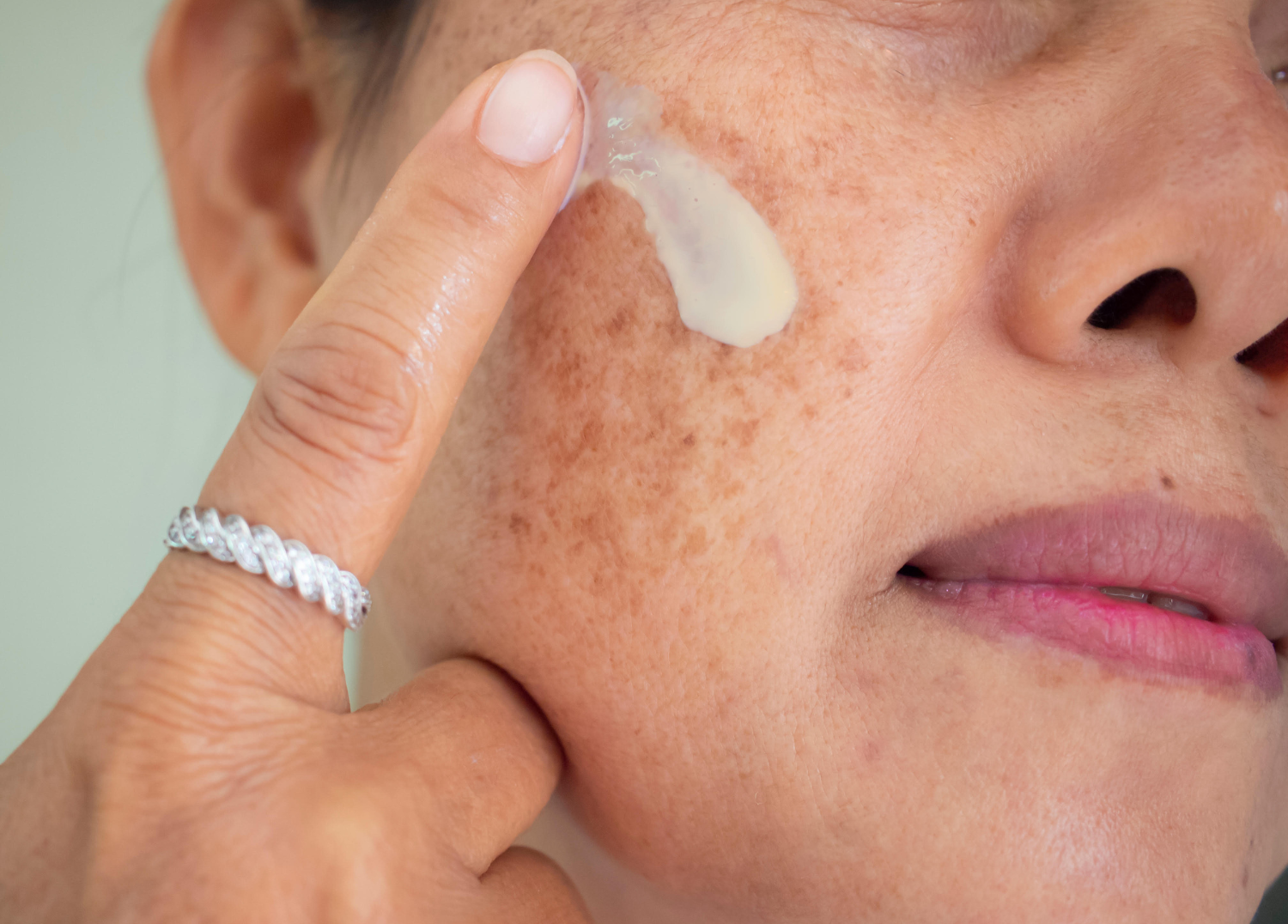 Tranexamic Acid: A Key Ingredient in Treating Hyperpigmentation