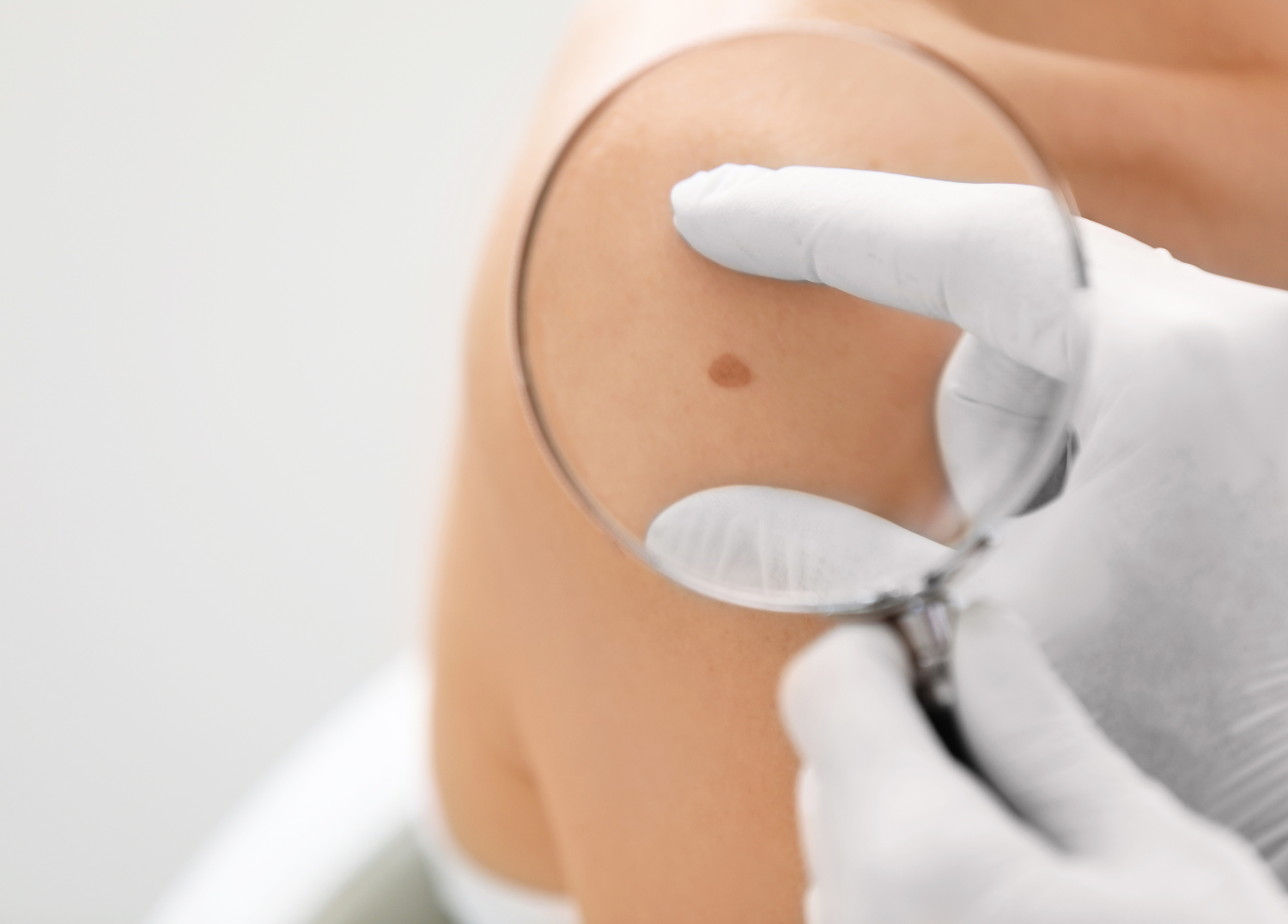 Shedding Light on Skin Cancer: Melanoma Awareness Month