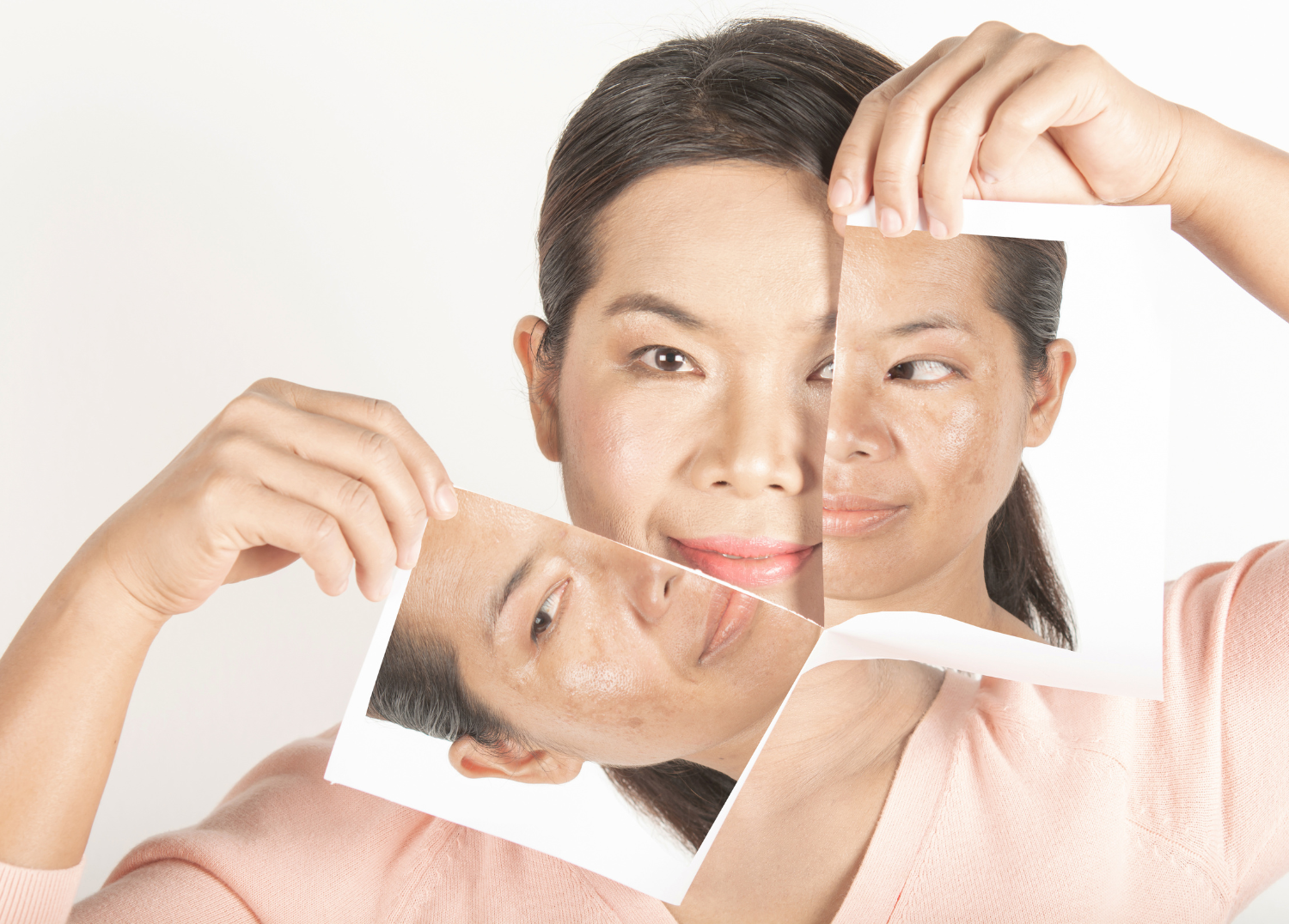 Sunspots: What Are They, How to Prevent Them, and Treatment Options