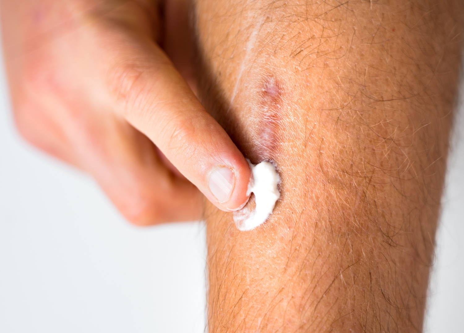 Using Skinuva Scar and Other Treatments to Improve Scars