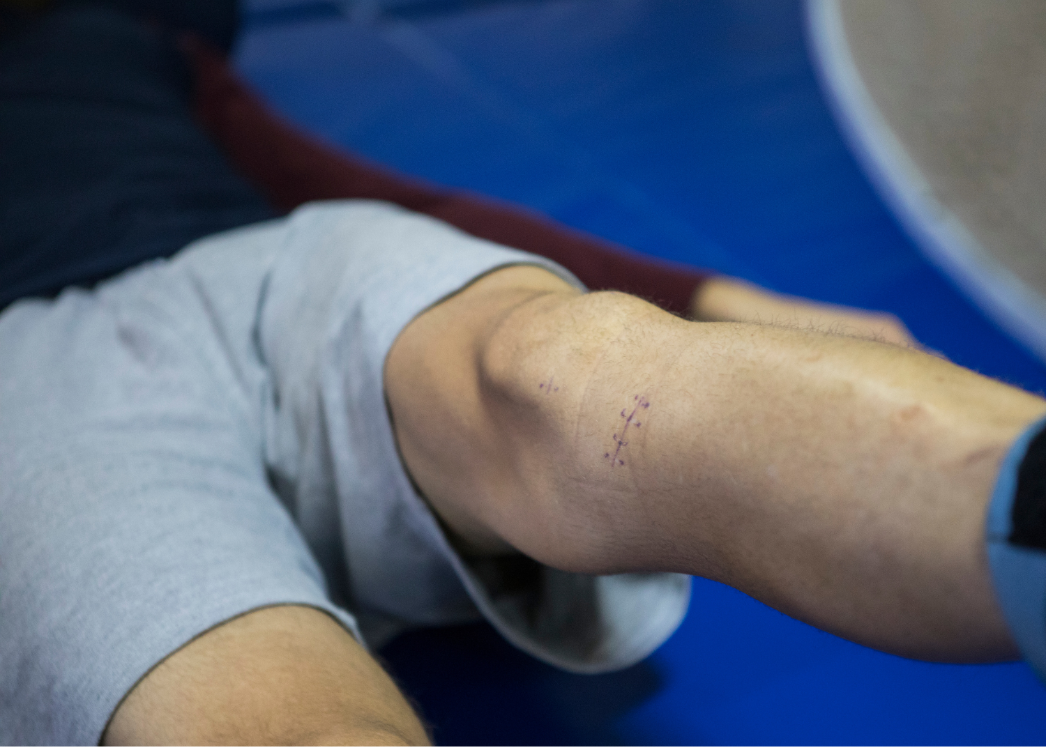 Using Skinuva for the Post-Orthopedic Surgery Healing Process