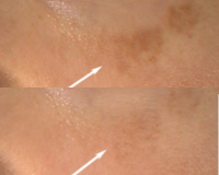 Left Cheek Melasma