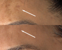 Forehead Melasma