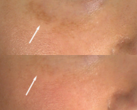 Right Cheek Melasma
