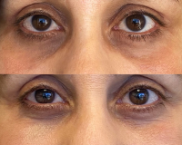 Under Eye Hyperpigmentation