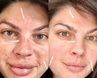 Pregnancy-Related Melasma