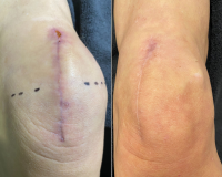 Knee Replacement Scar
