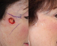 Mohs Surgery Scar