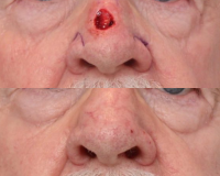 Mohs Surgery Scar