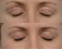 Upper Eyelid Scar