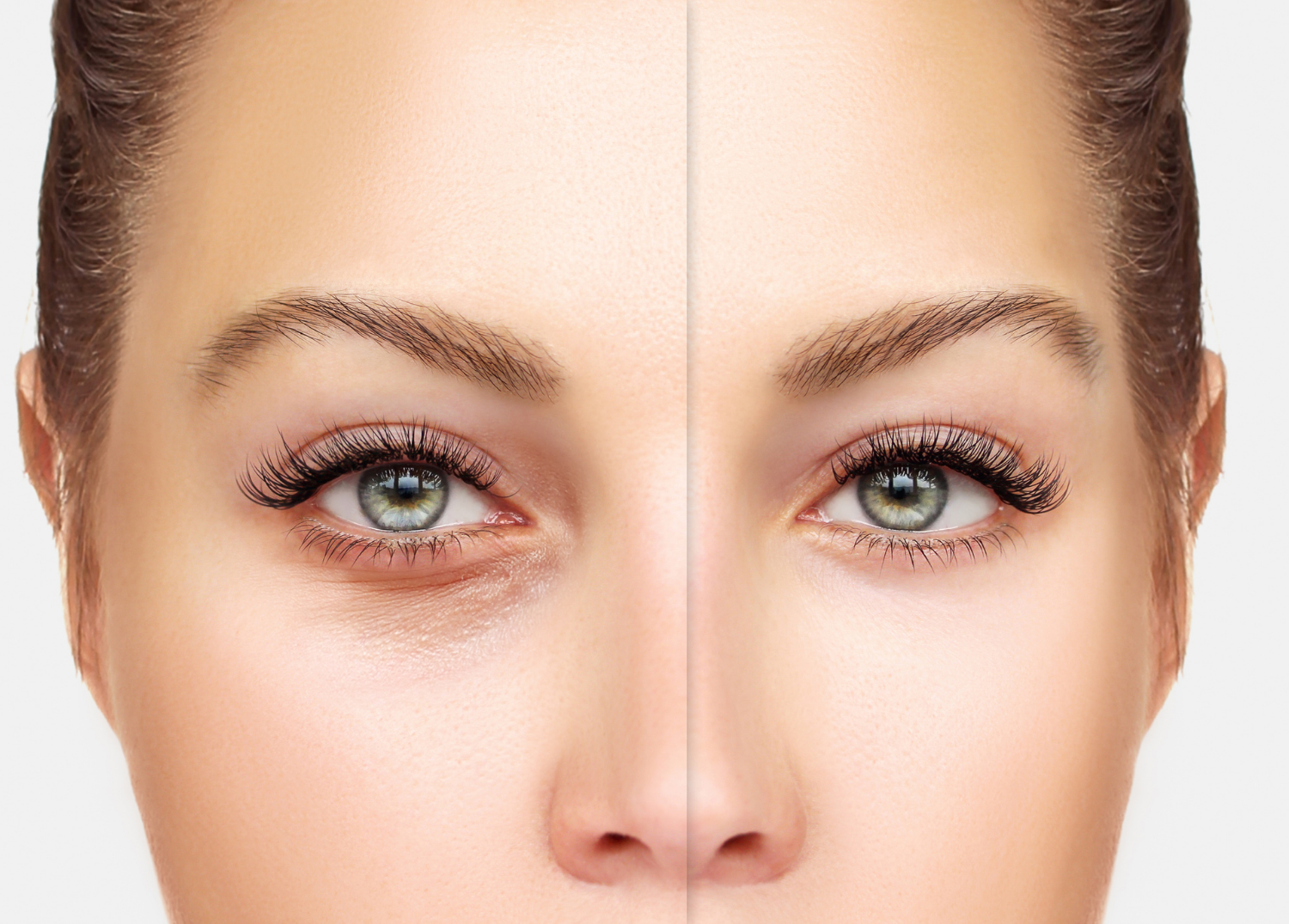 Causes of Under Eye Circles and How to Treat Them