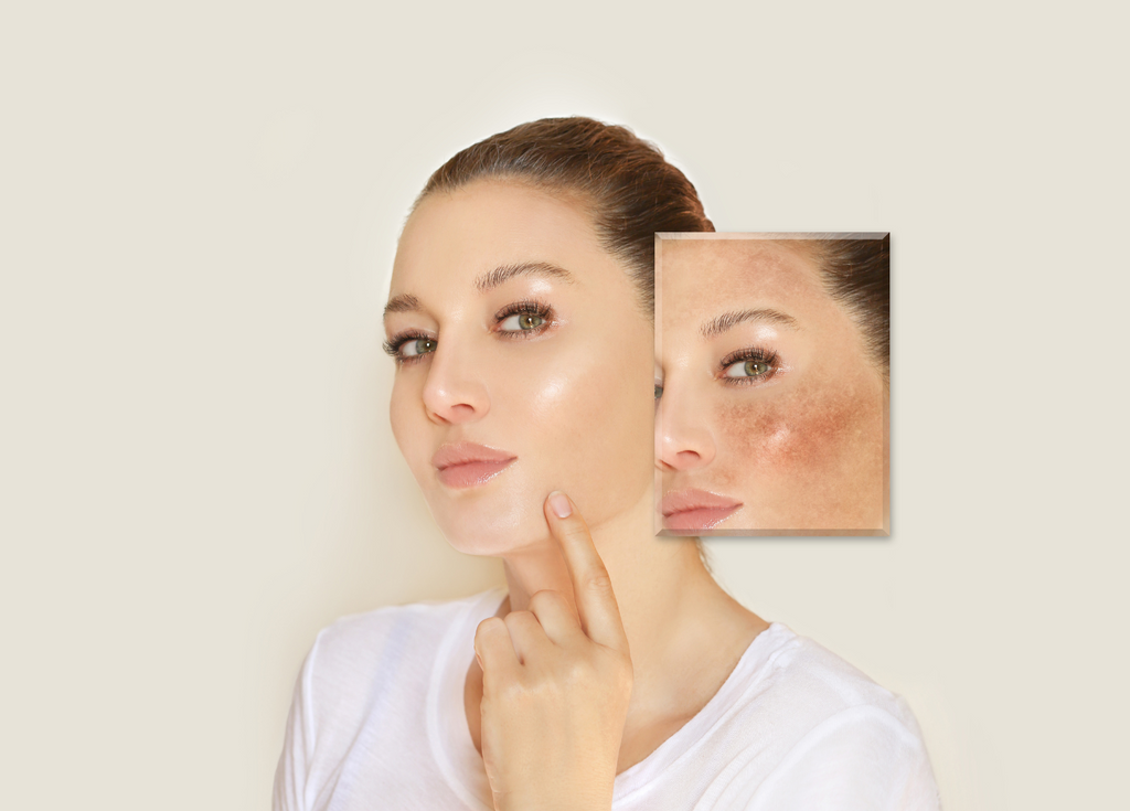 Preventing and Treating Melasma in the Summer Months