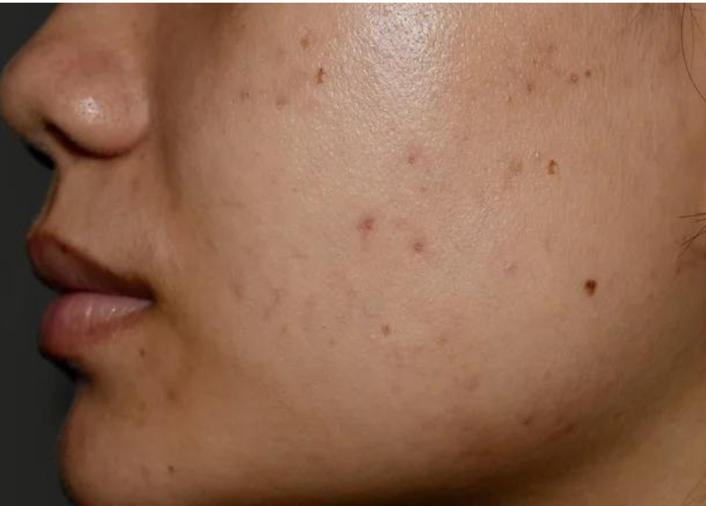 Causes, Prevention, and Treatment of Post-Inflammatory Hyperpigmentation