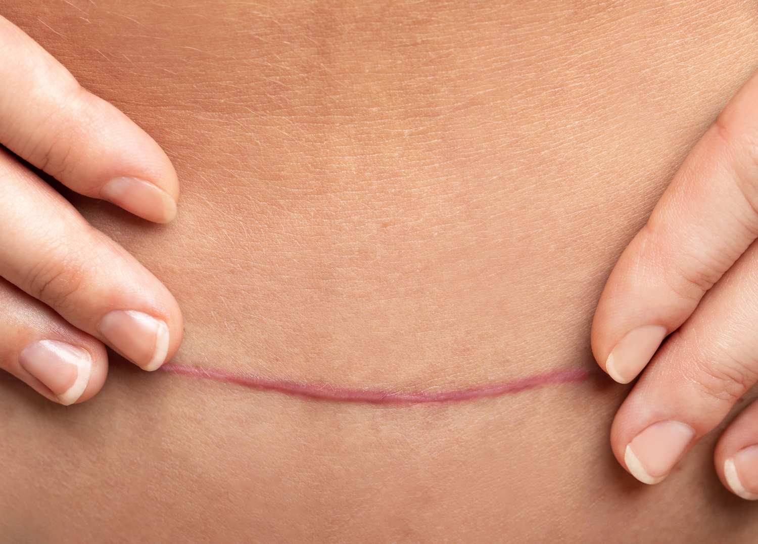 Understanding Scars: Different Types and Treatment Options