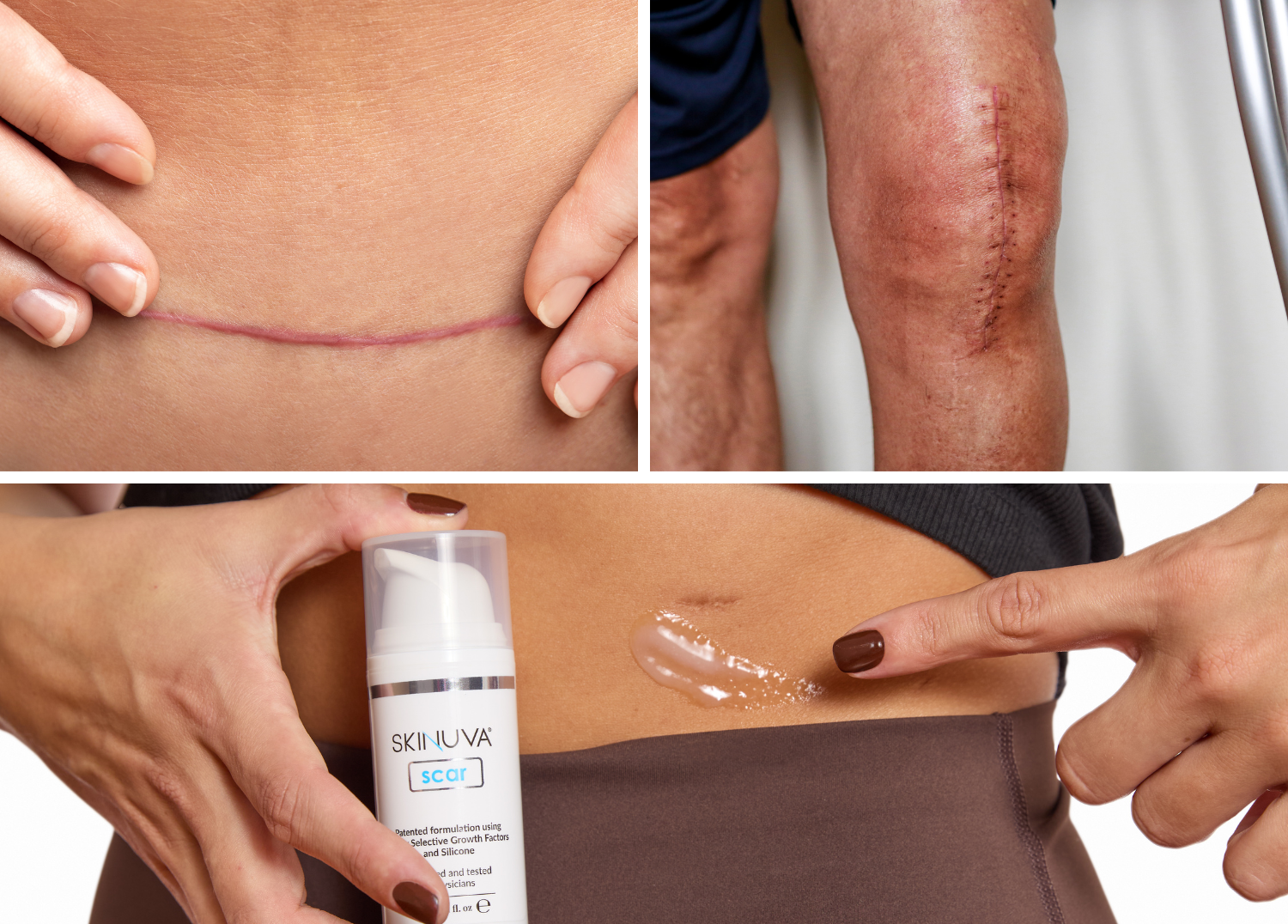 Why Scars Heal Differently and How Skinuva Scar Helps