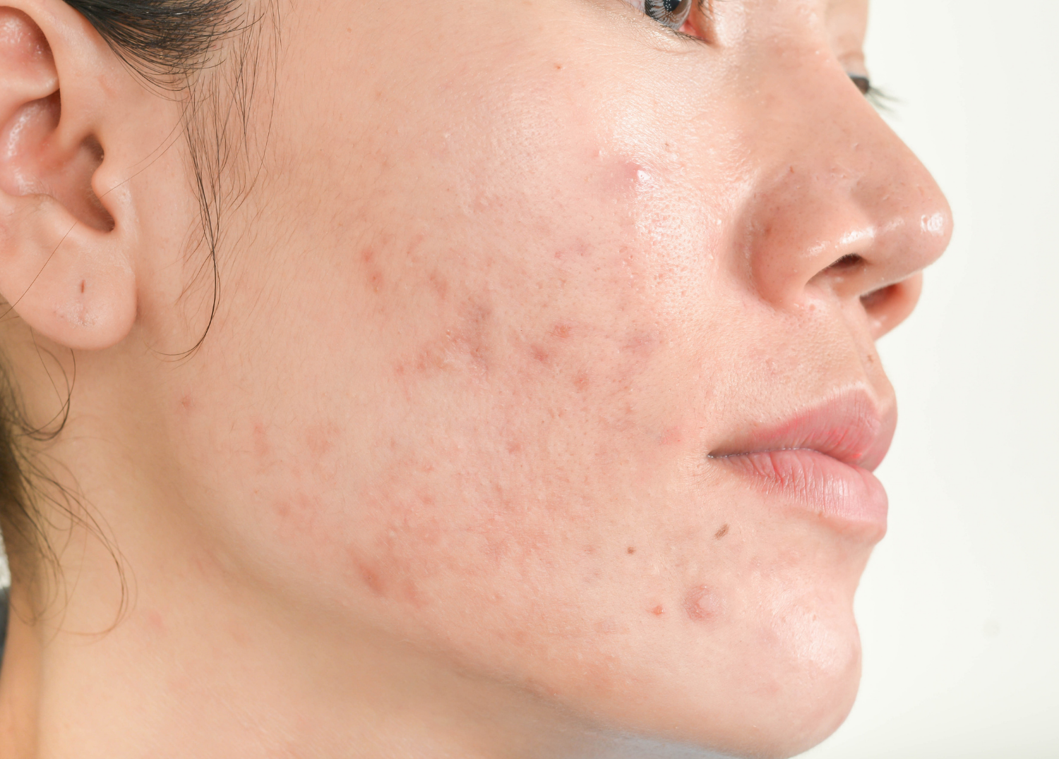 Different Types of Acne Scars and Marks and How Skinuva Products Can Help Treat Them