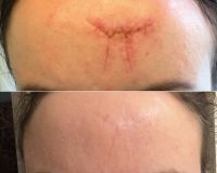 Scar from Forehead Injury