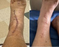 Scar from Arthoplasty on Ankle