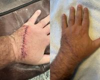 Scar from Hand Injury