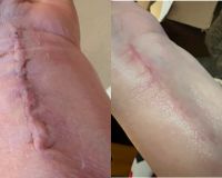 Scar from Wrist Surgery