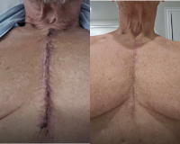Scar from Aortic Dissection