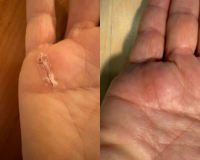 Scar from Hand Surgery