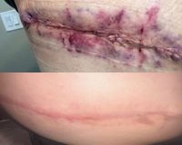 Scar from Hernia Removal
