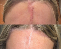Skin Cancer Removal Scar