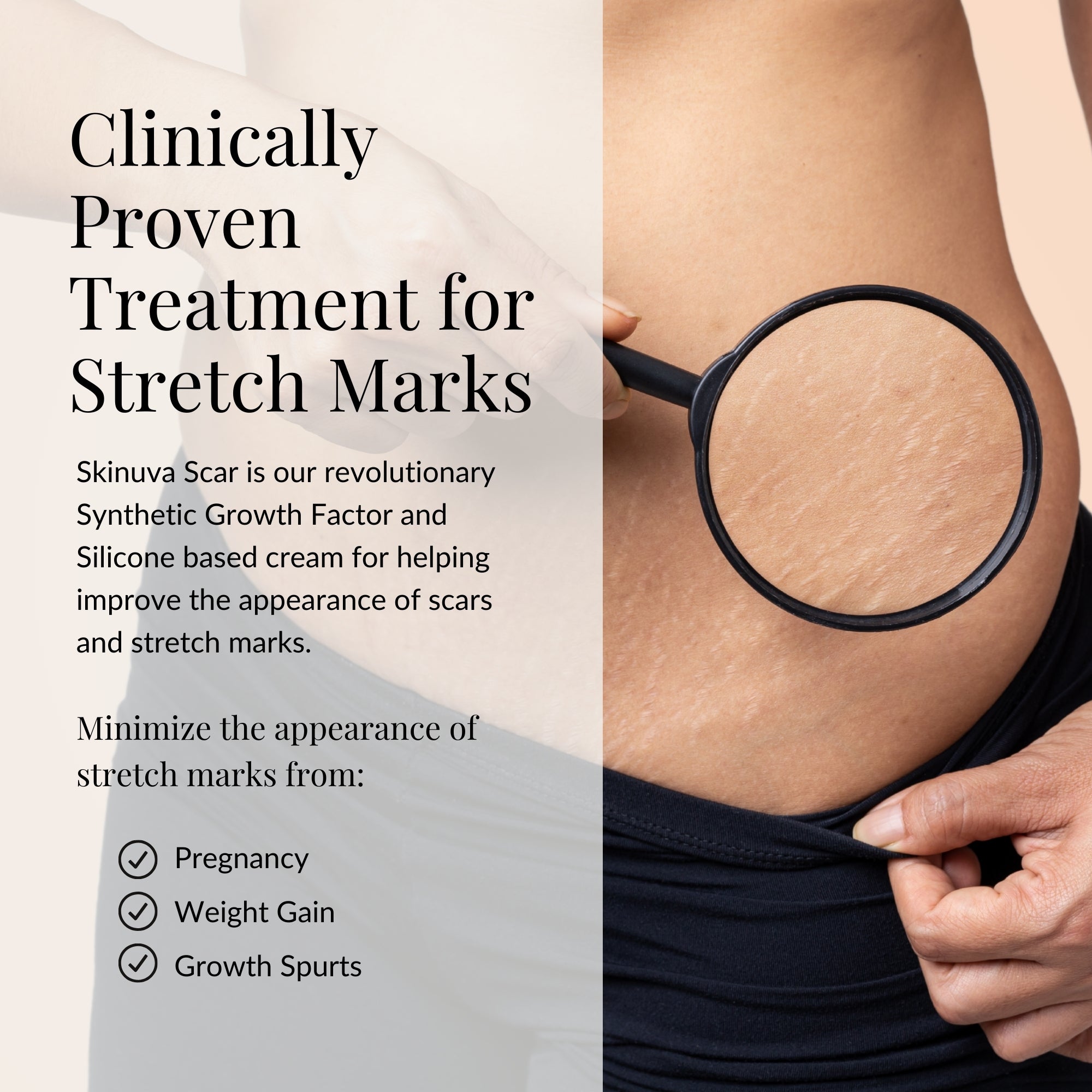Skinuva_Scar_75_ml_03_Stretch_Marks_Infographic.jpg